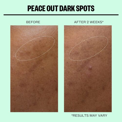 Peace Out- Dark Spots Micro Needling Dots IMPORTED - Image 4